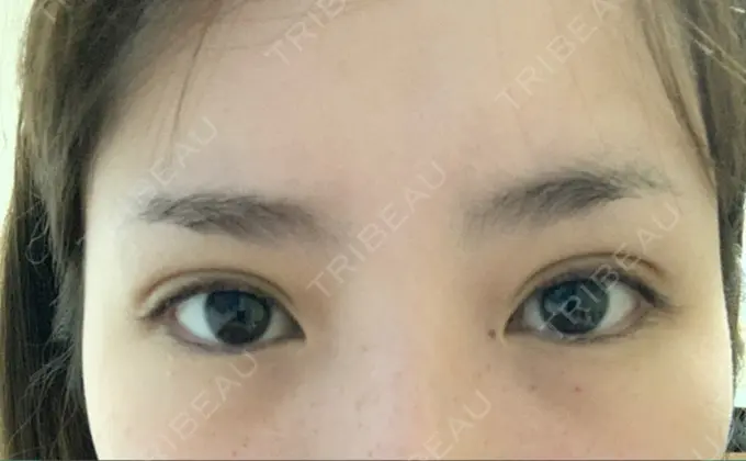 二重埋没 / 上まぶたの脂肪取り / 自然癒着法 FROM B整形外科 (旧バウム整形外科) DAY 19 メイン用