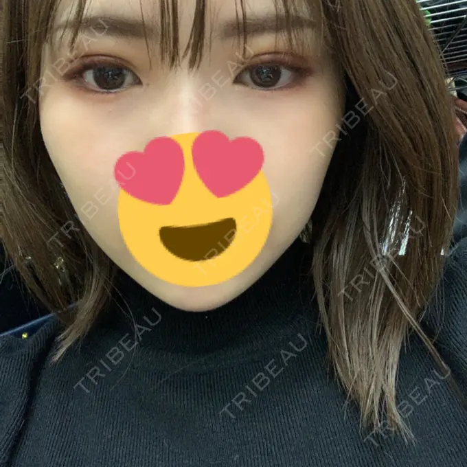 二重埋没 / 上まぶたの脂肪取り / 自然癒着法 FROM B整形外科 (旧バウム整形外科) DAY 19 メイン用