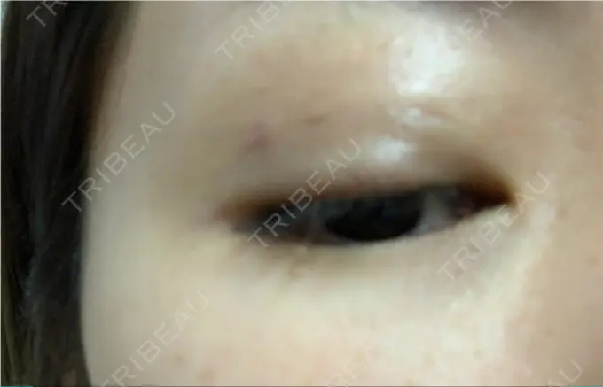 二重埋没 / 上まぶたの脂肪取り / 自然癒着法 FROM B整形外科 (旧バウム整形外科) DAY 19 メイン用