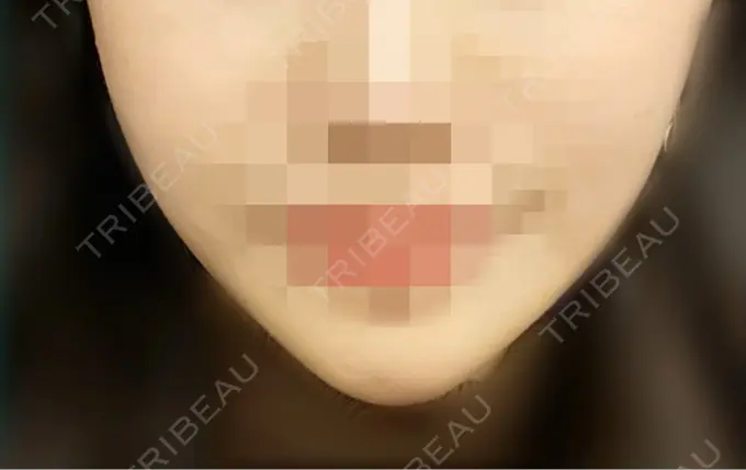 バッカルファット除去 藤・ナチュレ美容クリニック 恵比寿院 AFTER メイン用