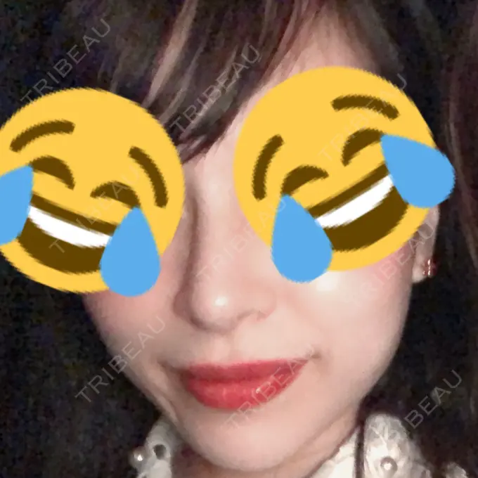 鼻尖形成（切開） / 小鼻縮小（切開） / 軟骨移植 / 骨切幅寄せ / ワシ鼻修正・ハンプ切除 FROM B整形外科 (旧バウム整形外科) DAY 87 メイン用