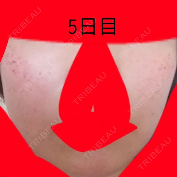 美肌レーザー / シミ取りレーザー / ルビーレーザー 銀座お肌の診療所 DAY 5 メイン用