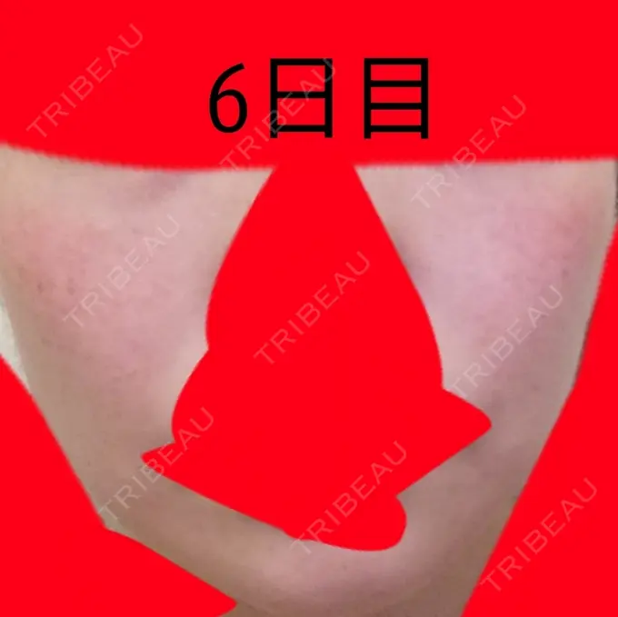 美肌レーザー / シミ取りレーザー / ルビーレーザー 銀座お肌の診療所 DAY 6 メイン用