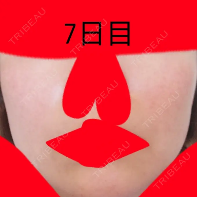 美肌レーザー / シミ取りレーザー / ルビーレーザー 銀座お肌の診療所 DAY 7 メイン用