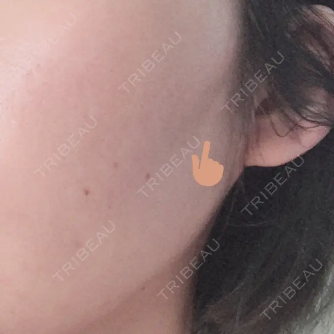 糸リフト 湘南美容クリニック 長野院 DAY 1 メイン用