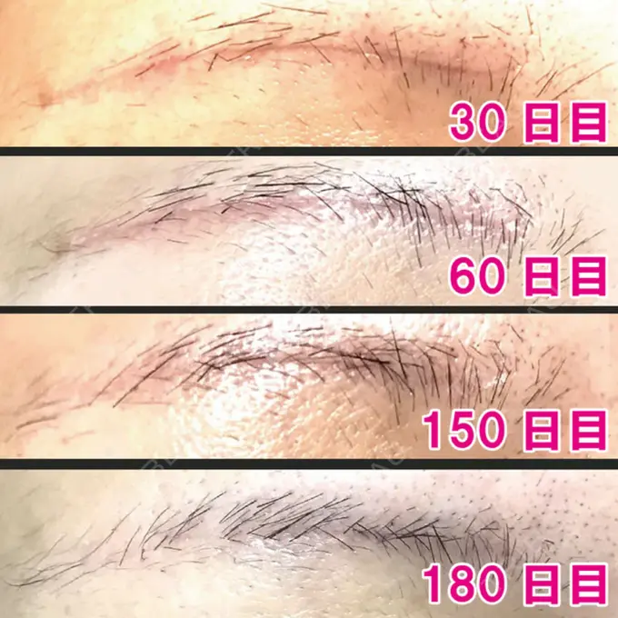 眉下切開 エイペックス美容外科 AFTER メイン用