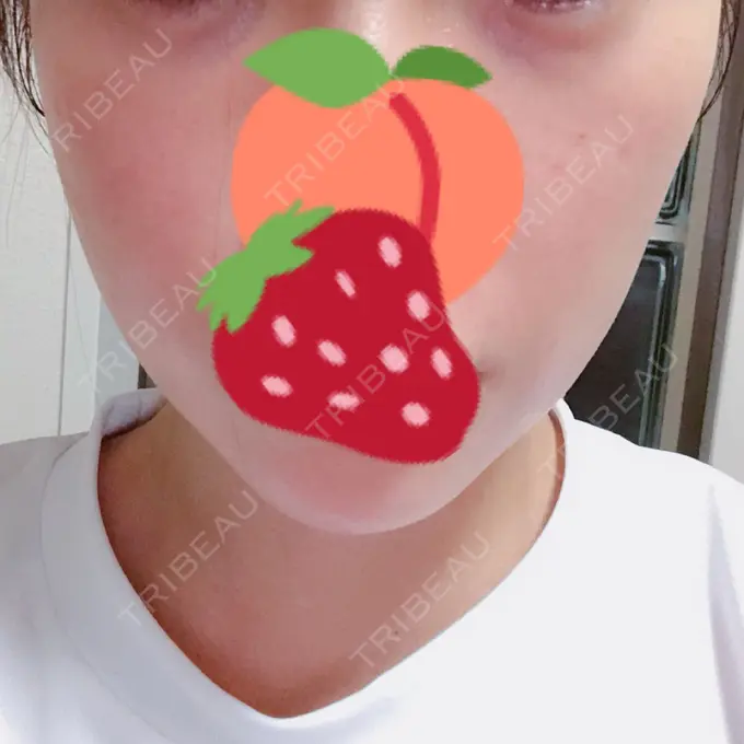 ハイフ（顔） リエンジャン整形外科 江南店 DAY 3 メイン用