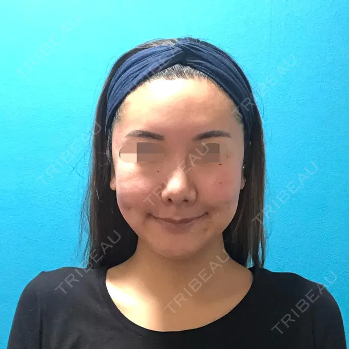 骨切り（あご） / 骨削り（頬） / ルフォー+ssro（両あご) / 輪郭修正 / 鼻翼基部形成（貴族手術） / その他（輪郭） エバーエム歯科 AFTER メイン用