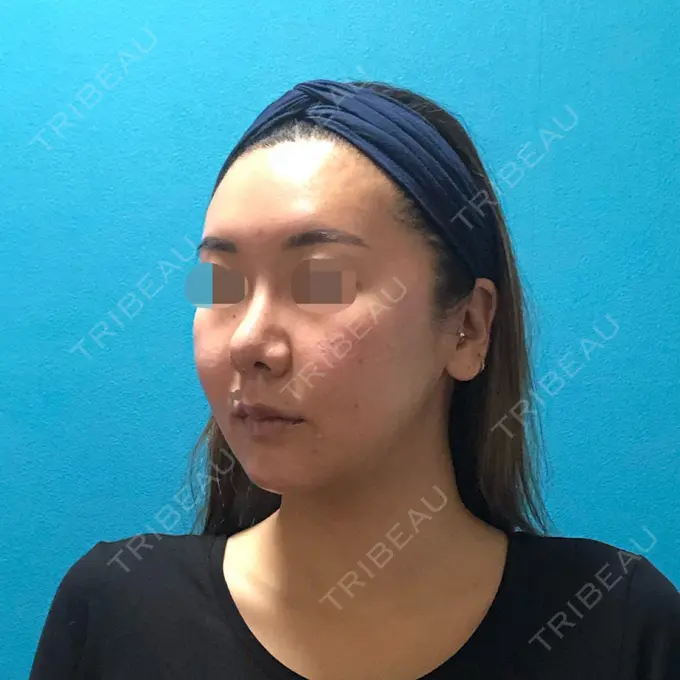 骨切り（あご） / 骨削り（頬） / ルフォー+ssro（両あご) / 輪郭修正 / 鼻翼基部形成（貴族手術） / その他（輪郭） エバーエム歯科 DAY 61 メイン用