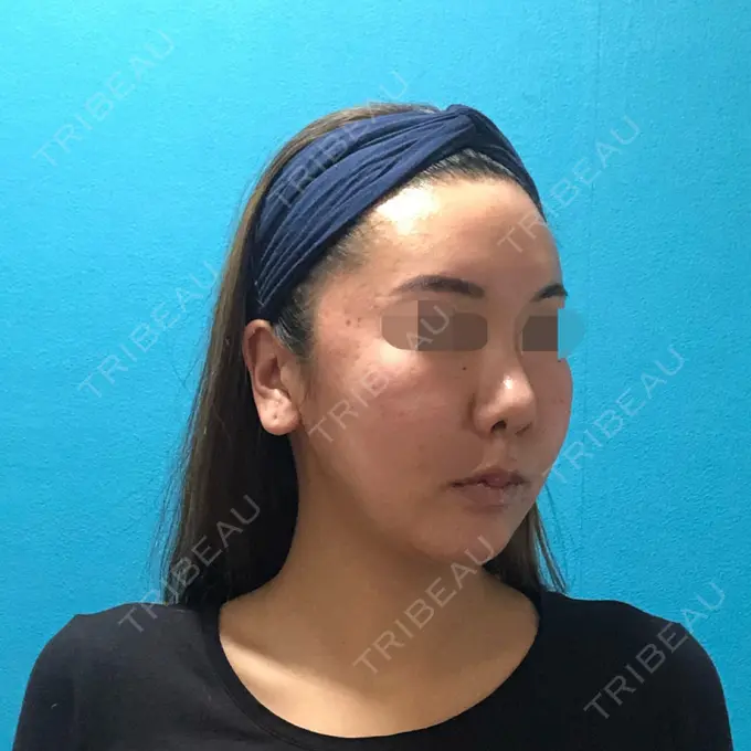 骨切り（あご） / 骨削り（頬） / ルフォー+ssro（両あご) / 輪郭修正 / 鼻翼基部形成（貴族手術） / その他（輪郭） エバーエム歯科 DAY 61 メイン用