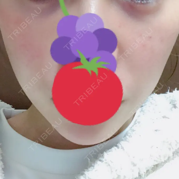 ハイフ（顔） リエンジャン整形外科 江南店 DAY 4 メイン用