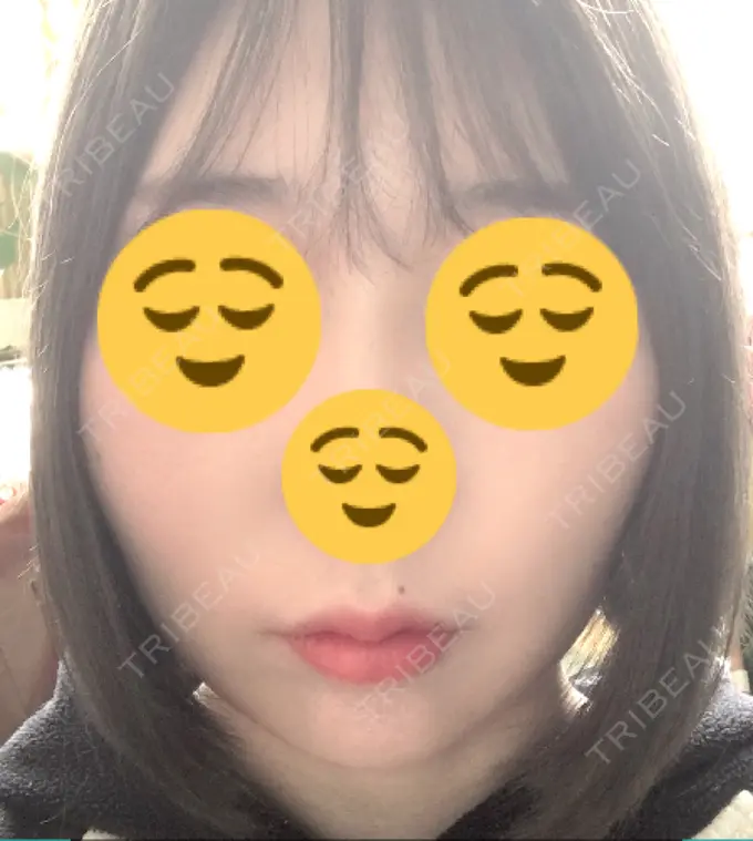 糸リフト 湘南美容クリニック 長野院 DAY 3 メイン用