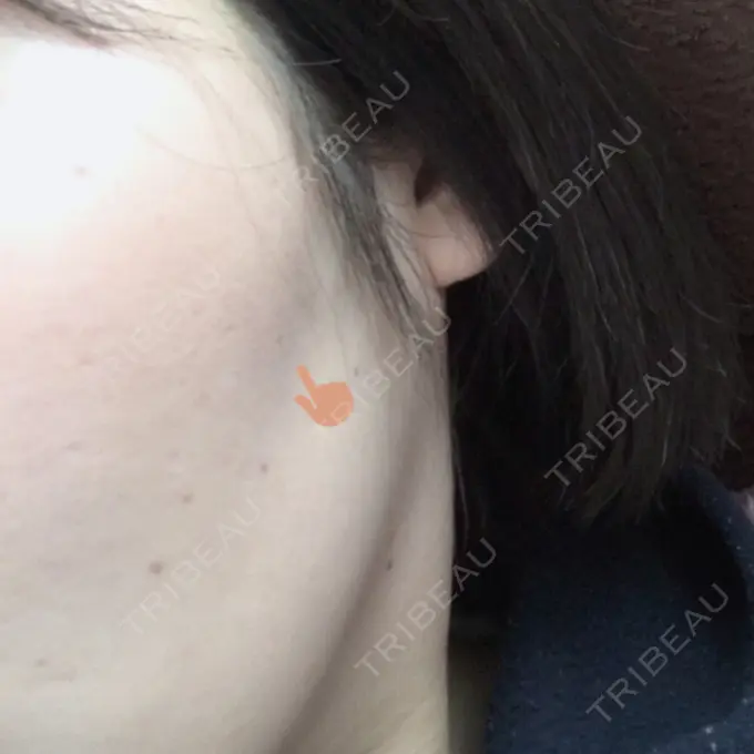 糸リフト 湘南美容クリニック 長野院 DAY 3 メイン用