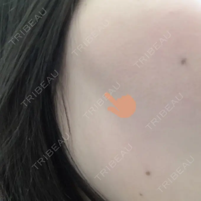 糸リフト 湘南美容クリニック 長野院 DAY 3 メイン用