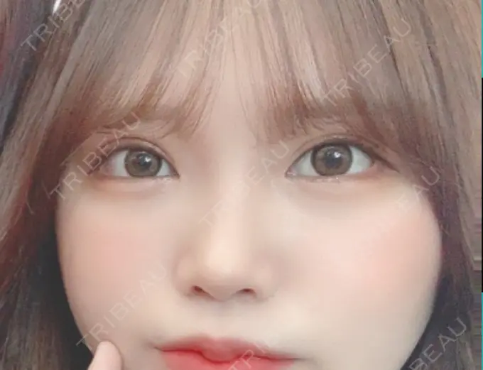 目尻切開 / 目元修正 / 目尻靭帯移動 DIVINE（ディバイン）整形外科 AFTER メイン用