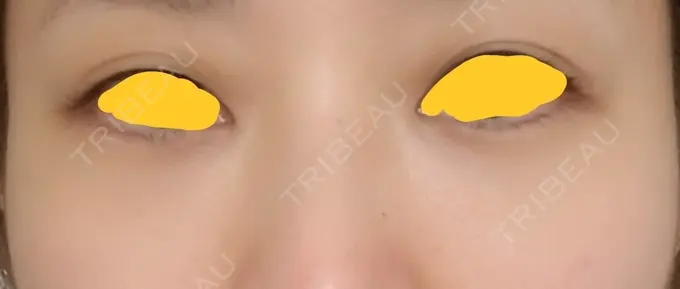 クマ治療 韓国ST美容整形外科 DAY 142 メイン用