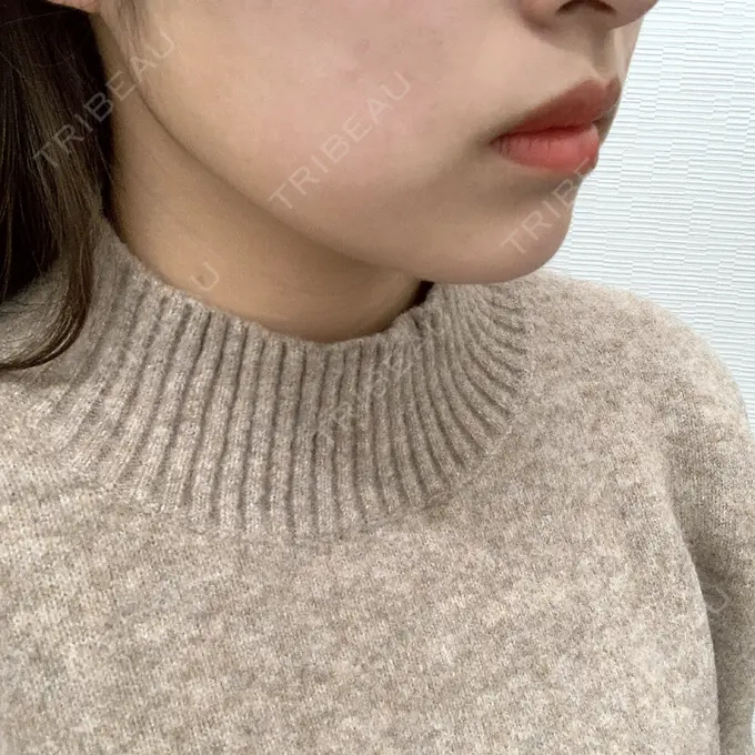 ボトックス（エラ・小顔） TCB東京中央美容外科 堺院 DAY 38 メイン用