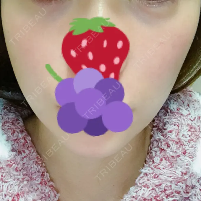 ハイフ（顔） リエンジャン整形外科 江南店 DAY 6 メイン用