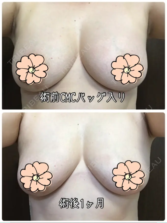 豊胸（脂肪注入） / 胸修正 / 脂肪注入（額） THE CLINIC（ザ・クリニック） 大阪院 DAY 30 メイン用