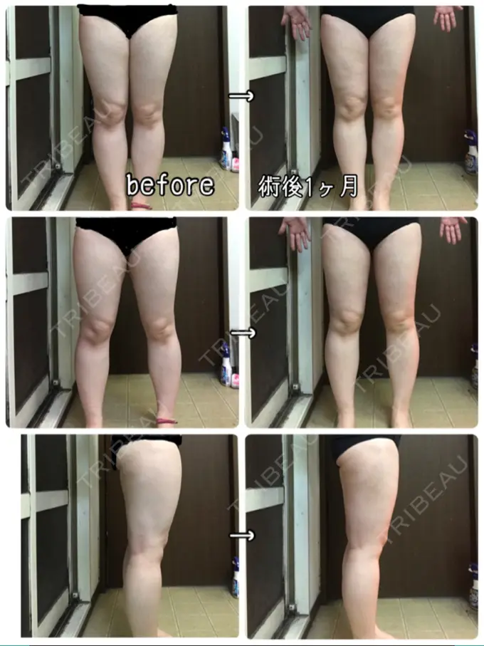 豊胸（脂肪注入） / 胸修正 / 脂肪注入（額） THE CLINIC（ザ・クリニック） 大阪院 DAY 30 メイン用