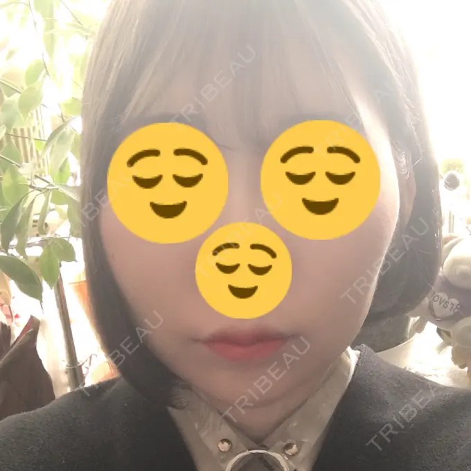 糸リフト 湘南美容クリニック 長野院 DAY 5 メイン用