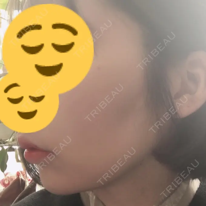 糸リフト 湘南美容クリニック 長野院 DAY 5 メイン用