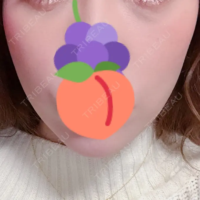 ハイフ（顔） リエンジャン整形外科 江南店 DAY 7 メイン用