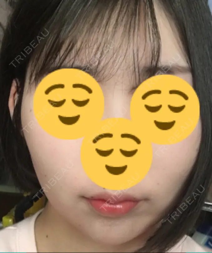 糸リフト 湘南美容クリニック 長野院 AFTER メイン用