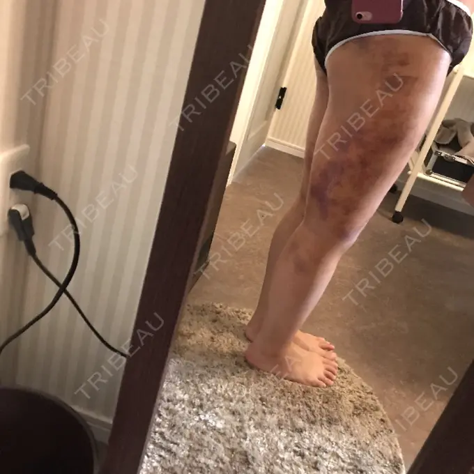 脂肪吸引（脚） / 脂肪吸引（お尻） 湘南美容クリニック 仙台院 DAY 8 メイン用