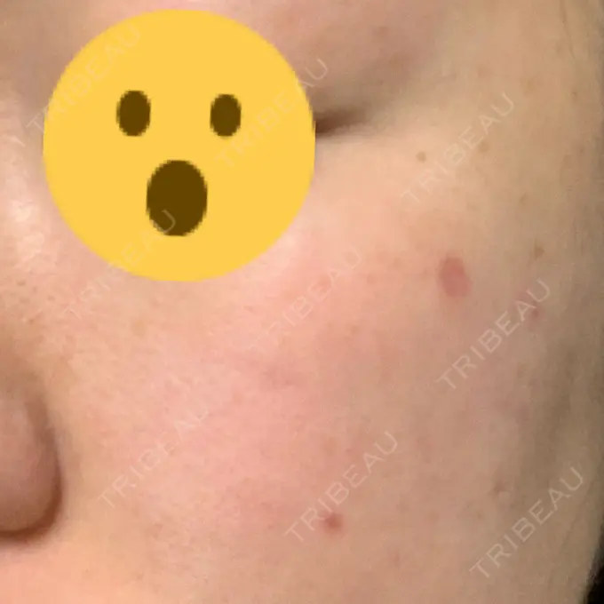 ほくろ・いぼ切除（肌） 医療法人美彩会 グランクリニック DAY 15 メイン用