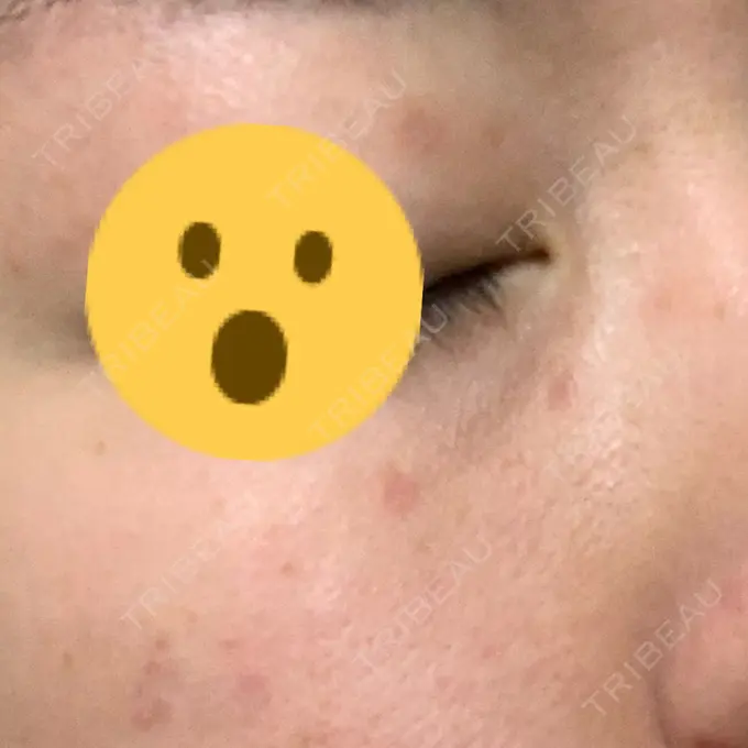 ほくろ・いぼ切除（肌） 医療法人美彩会 グランクリニック DAY 15 メイン用