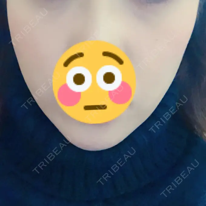 ハイフ（顔） リエンジャン整形外科 江南店 DAY 9 メイン用