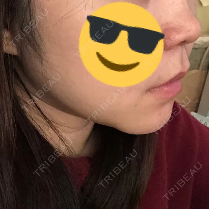 二重埋没 / 目頭切開 / ルフォー+ssro（両あご) / 輪郭修正 View美容整形外科 DAY 153 メイン用