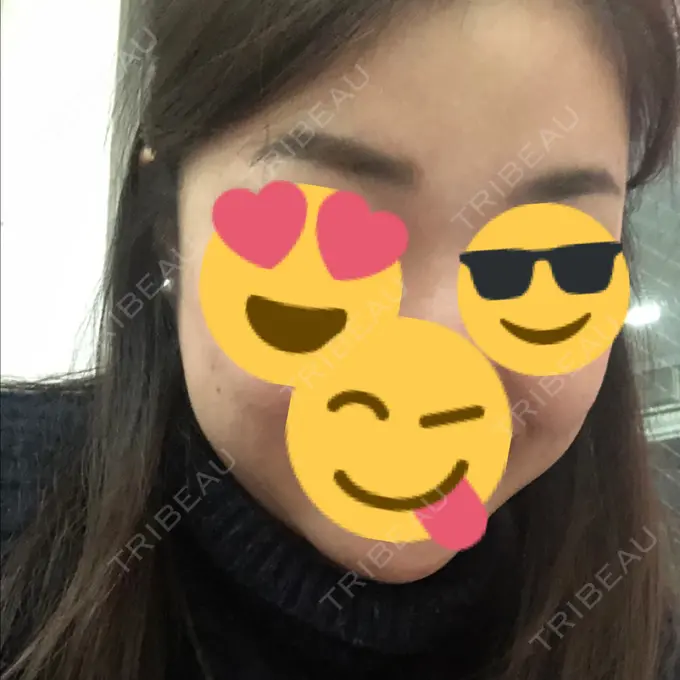 二重埋没 / 目頭切開 / ルフォー+ssro（両あご) / 輪郭修正 View美容整形外科 DAY 153 メイン用