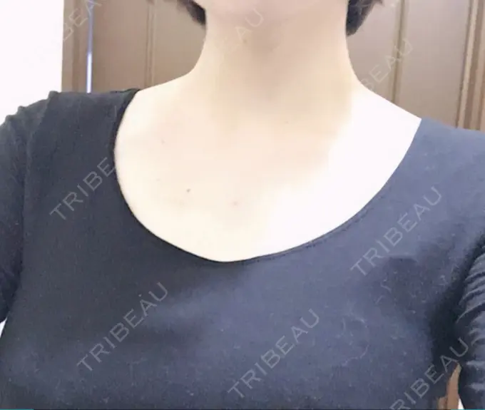 ボトックス（肩） 洗足整形・形成外科 AFTER メイン用