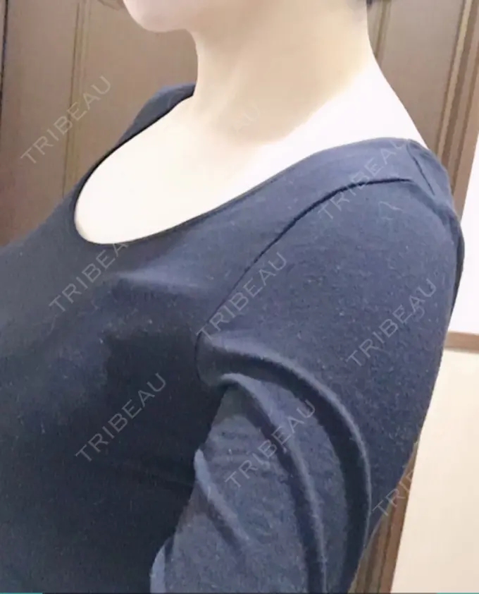 ボトックス（肩） 洗足整形・形成外科 DAY 0 メイン用