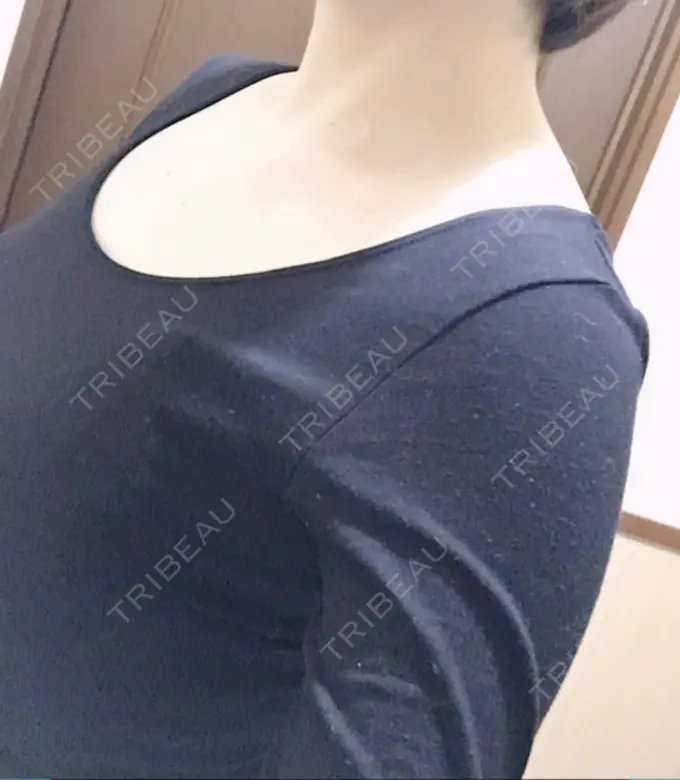 ボトックス（肩） 洗足整形・形成外科 DAY 0 メイン用