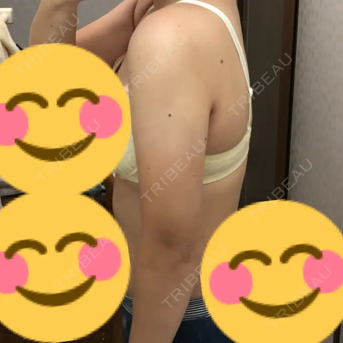 脂肪吸引（二の腕） 湘南美容クリニック 岡山院 DAY 42 メイン用