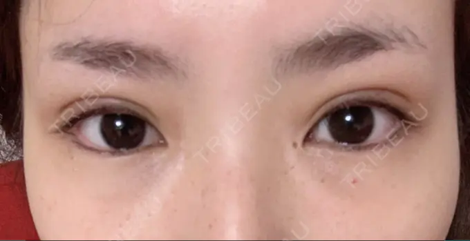 二重埋没 / 上まぶたの脂肪取り / 自然癒着法 FROM B整形外科 (旧バウム整形外科) DAY 30 メイン用