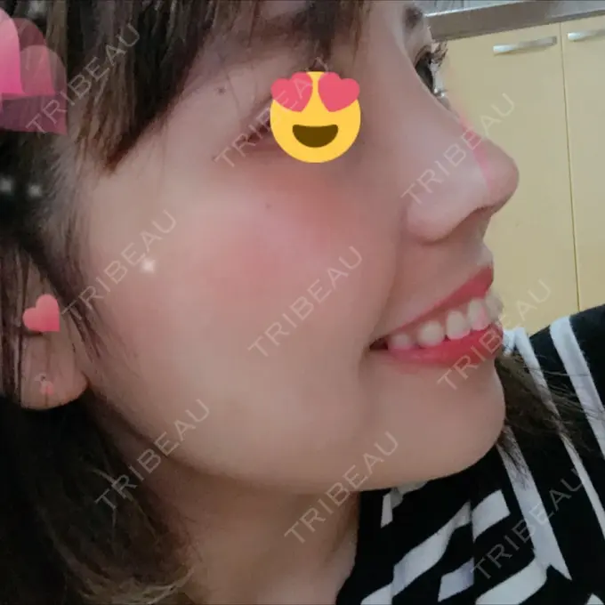 隆鼻術 / 鼻尖形成（切開） / 鼻中隔延長（切開） / 眉間プロテーゼ FROM B整形外科 (旧バウム整形外科) DAY 10 メイン用