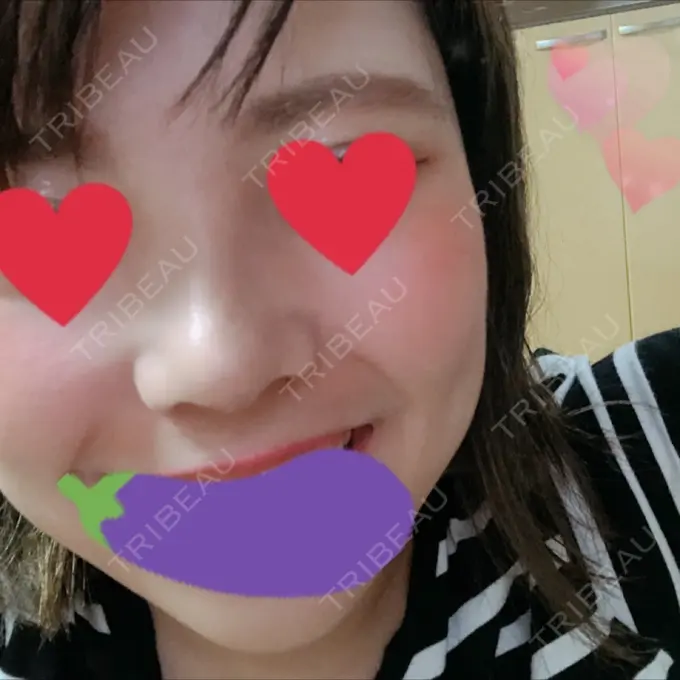 隆鼻術 / 鼻尖形成（切開） / 鼻中隔延長（切開） / 眉間プロテーゼ FROM B整形外科 (旧バウム整形外科) DAY 10 メイン用