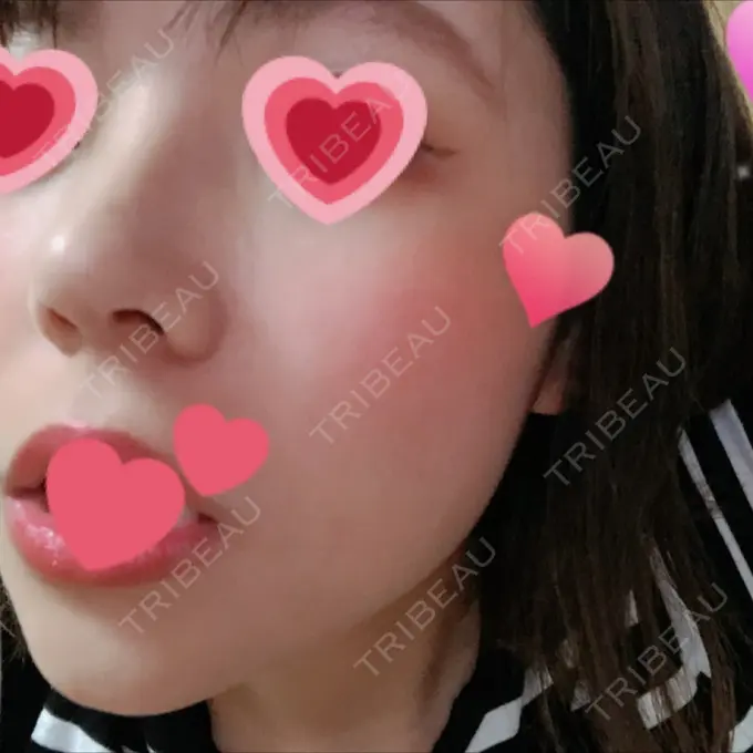 隆鼻術 / 鼻尖形成（切開） / 鼻中隔延長（切開） / 眉間プロテーゼ FROM B整形外科 (旧バウム整形外科) DAY 10 メイン用