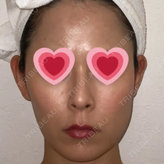 ボトックス（エラ・小顔） もとび美容外科クリニック 新宿院 DAY 35 メイン用