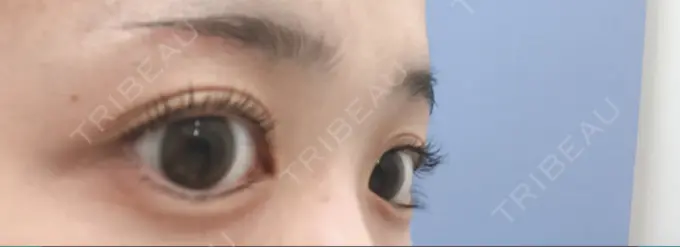 眉下切開 / その他（目元） 湘南美容クリニック 秋葉原院 DAY 94 メイン用