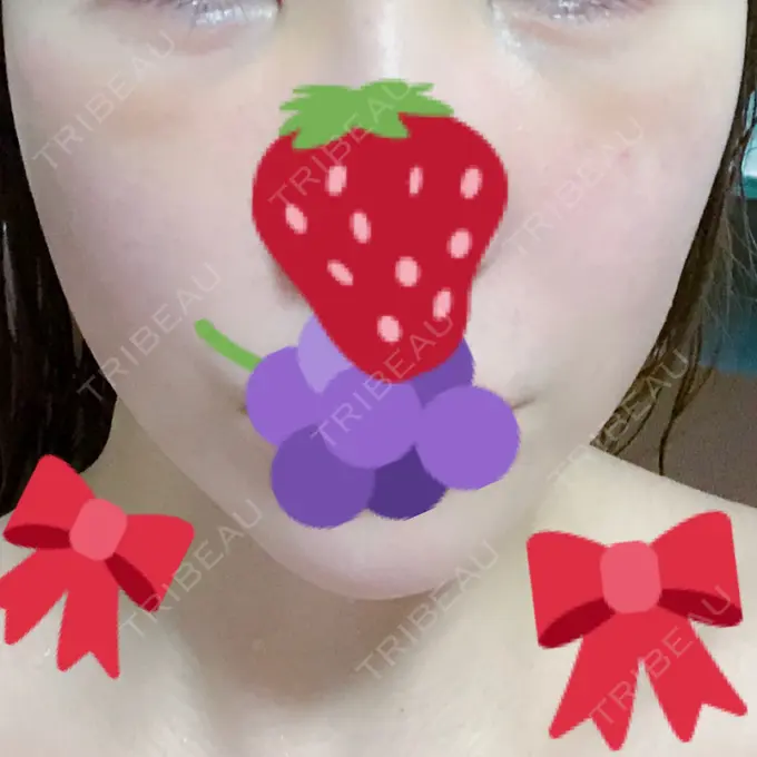 ハイフ（顔） リエンジャン整形外科 江南店 DAY 14 メイン用