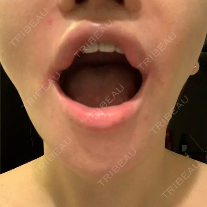 口角挙上 現代美学整形外科 DAY 17 メイン用