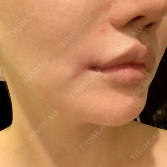 口角挙上 現代美学整形外科 DAY 17 メイン用