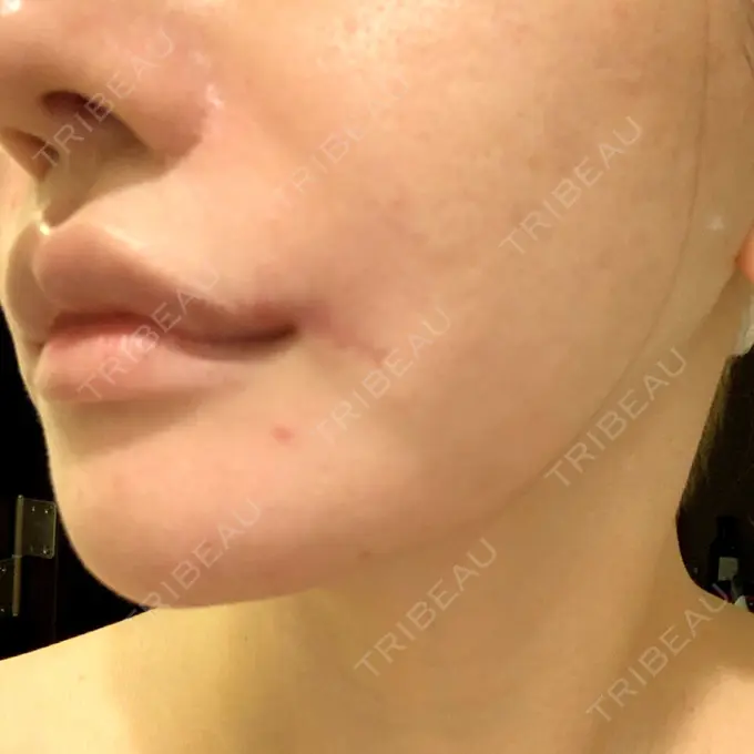 口角挙上 現代美学整形外科 DAY 17 メイン用