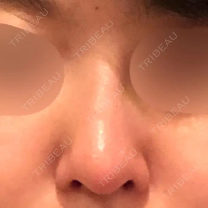 隆鼻術 / 軟骨移植 みずほクリニック DAY 9 メイン用