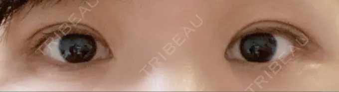 二重切開 水の森美容クリニック 名古屋院 DAY 81 メイン用